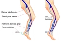 Damarda Pıhtı Belirtileri ve Tedavisi