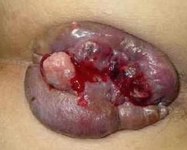 Gebelikte Kan Pıhtısı Gelmesi Nedenleri